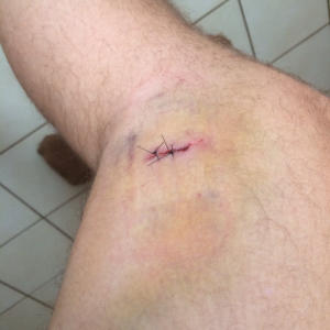 Dog Bite Stitches